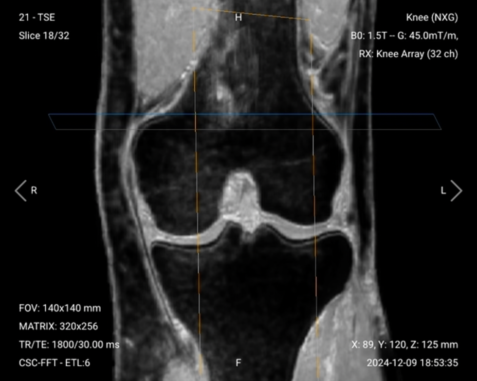 Coronal PD FS of the Knee – Correct Image