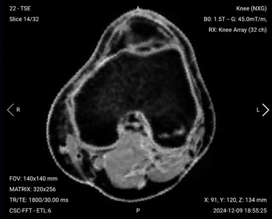 Axial PD FS of the Knee – Correct Image