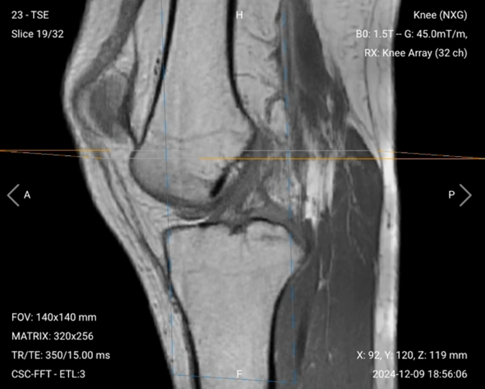 Sagittal T1 of the Knee – Correct Image
