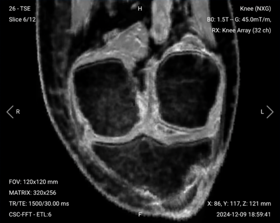 Coronal PD FS ACL – Correct Image
