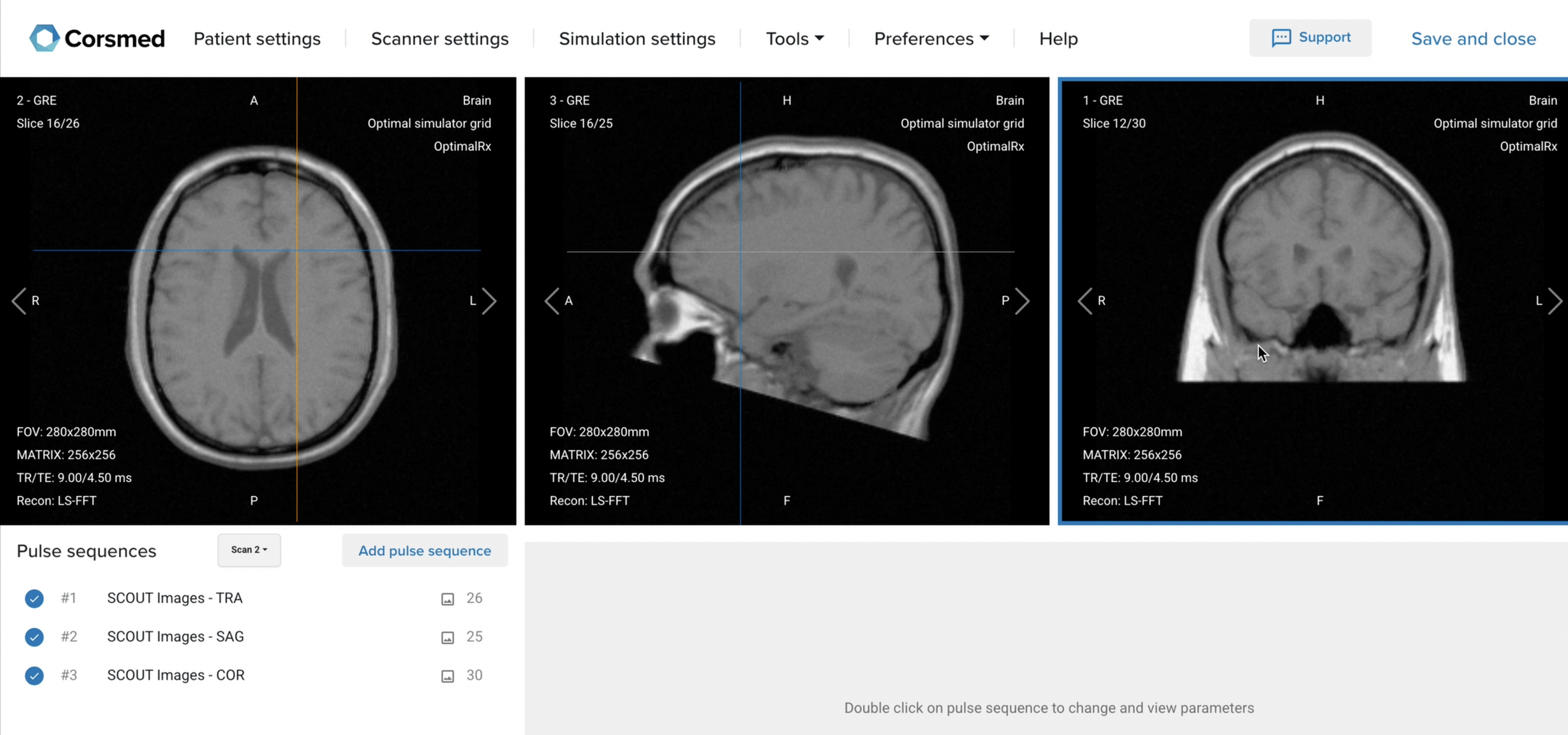 Correct setup of localizer images for routine brain MRI protocol on the Corsmed MRI Simulator