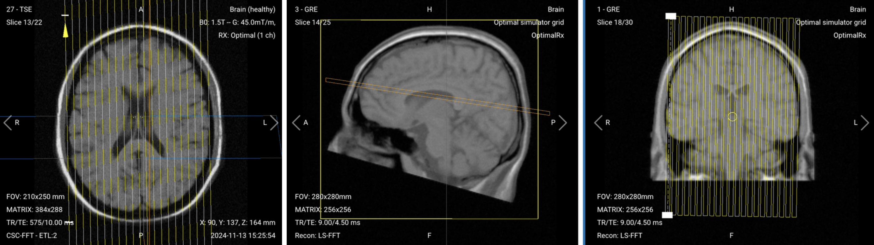 Correct Planning of Sagittal T1 TSE for routine brain MRI