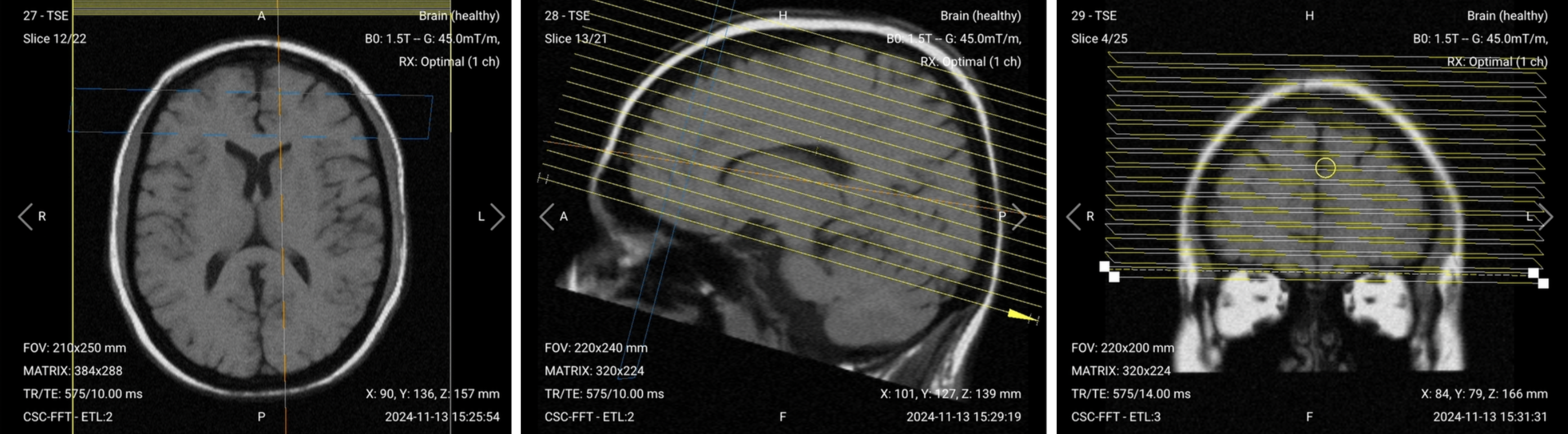 Correct Planning of Axial Diffusion-Weighted Imaging (DWI) for routine brain MRI