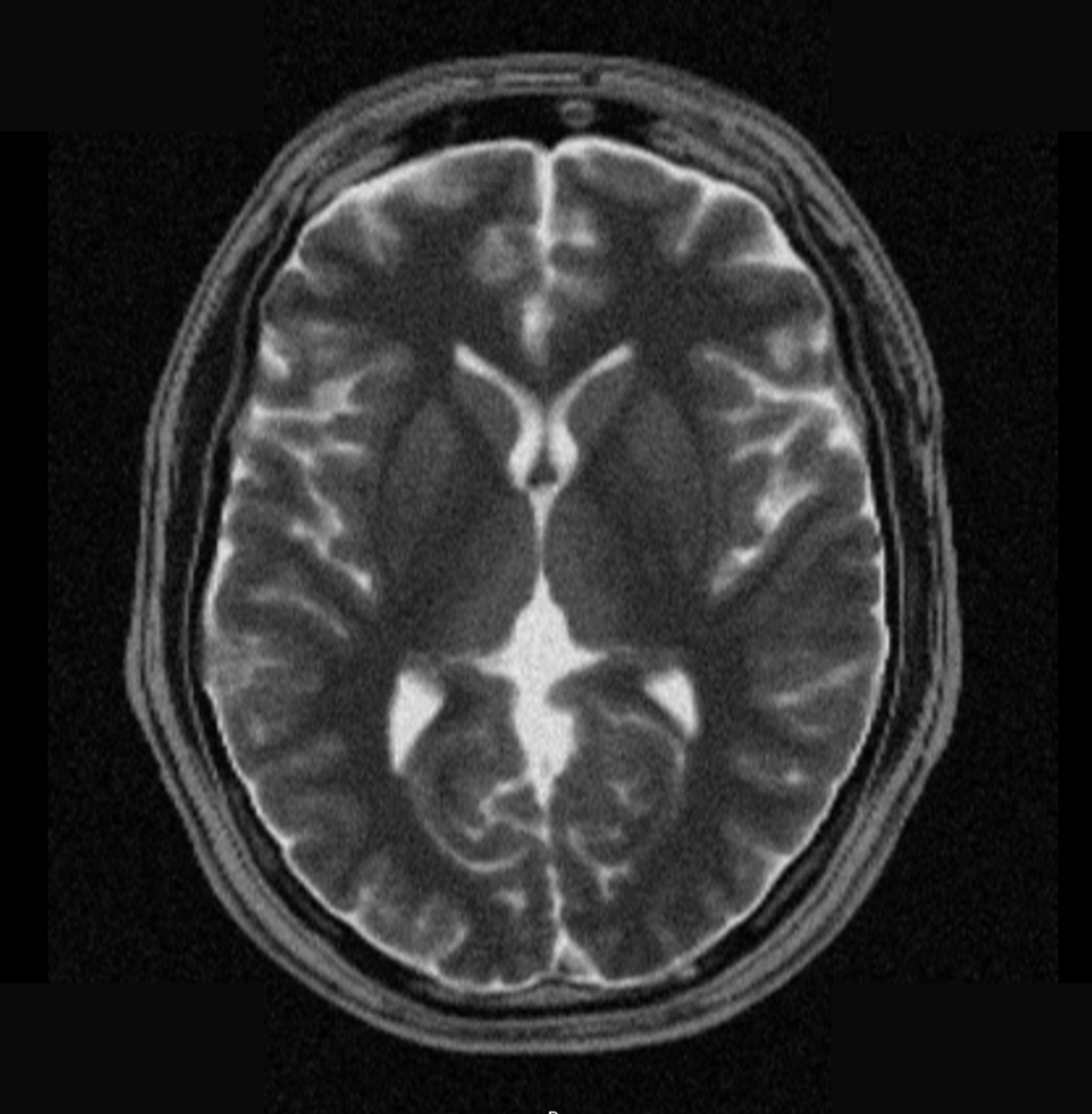 Axial T2 of the Brain – Correct Image