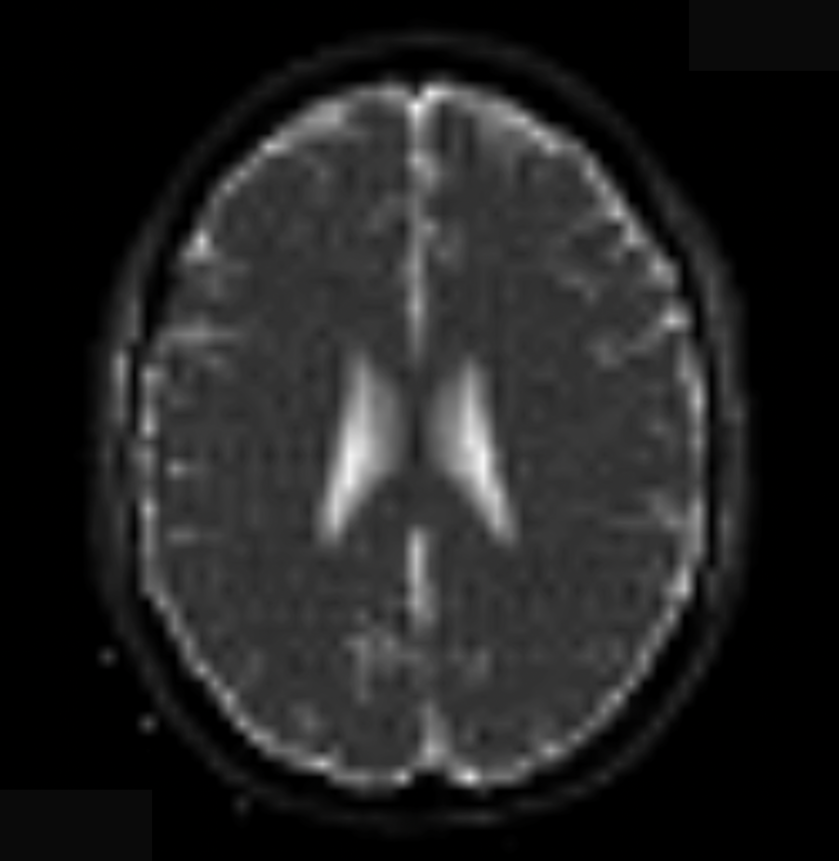 ADC Map (Apparent Diffusion Coefficient) – Correct Image