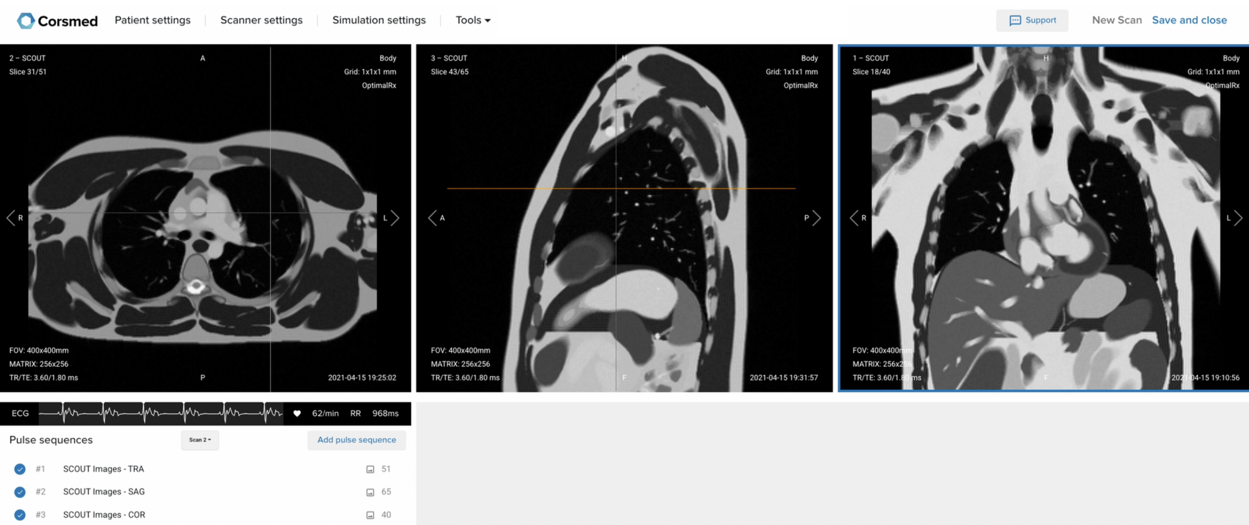 Correct Setup of Localizer Images for Cardiac Viability MRI