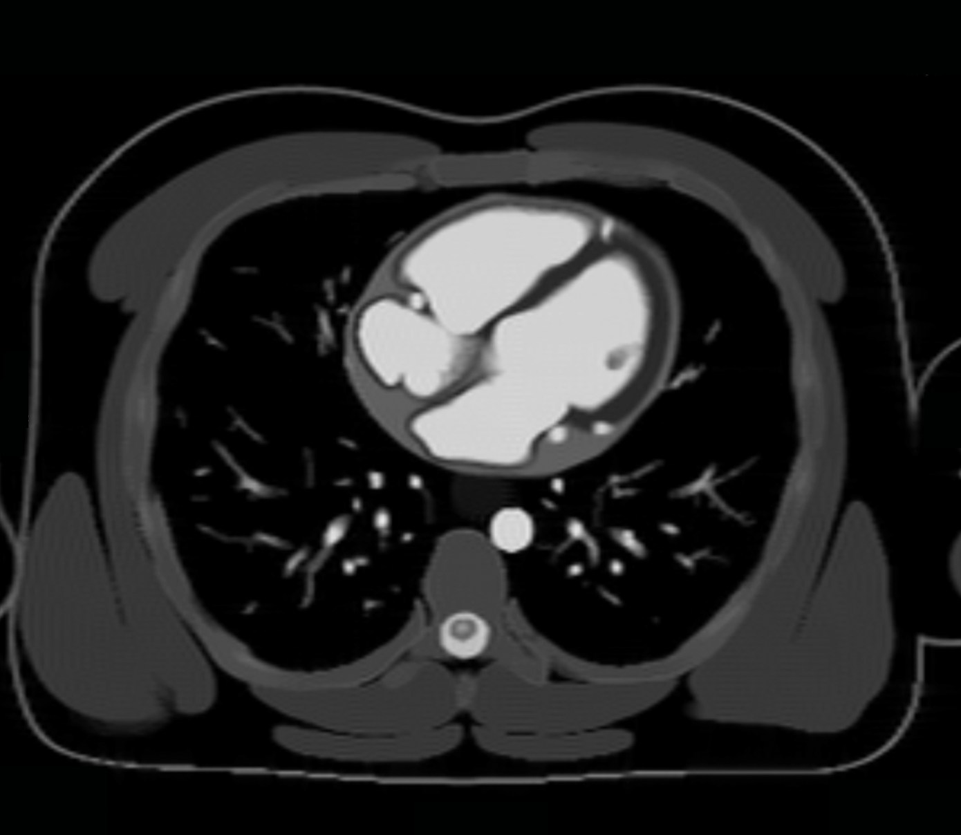 Bright Blood IR-TSE – Correct Image Example