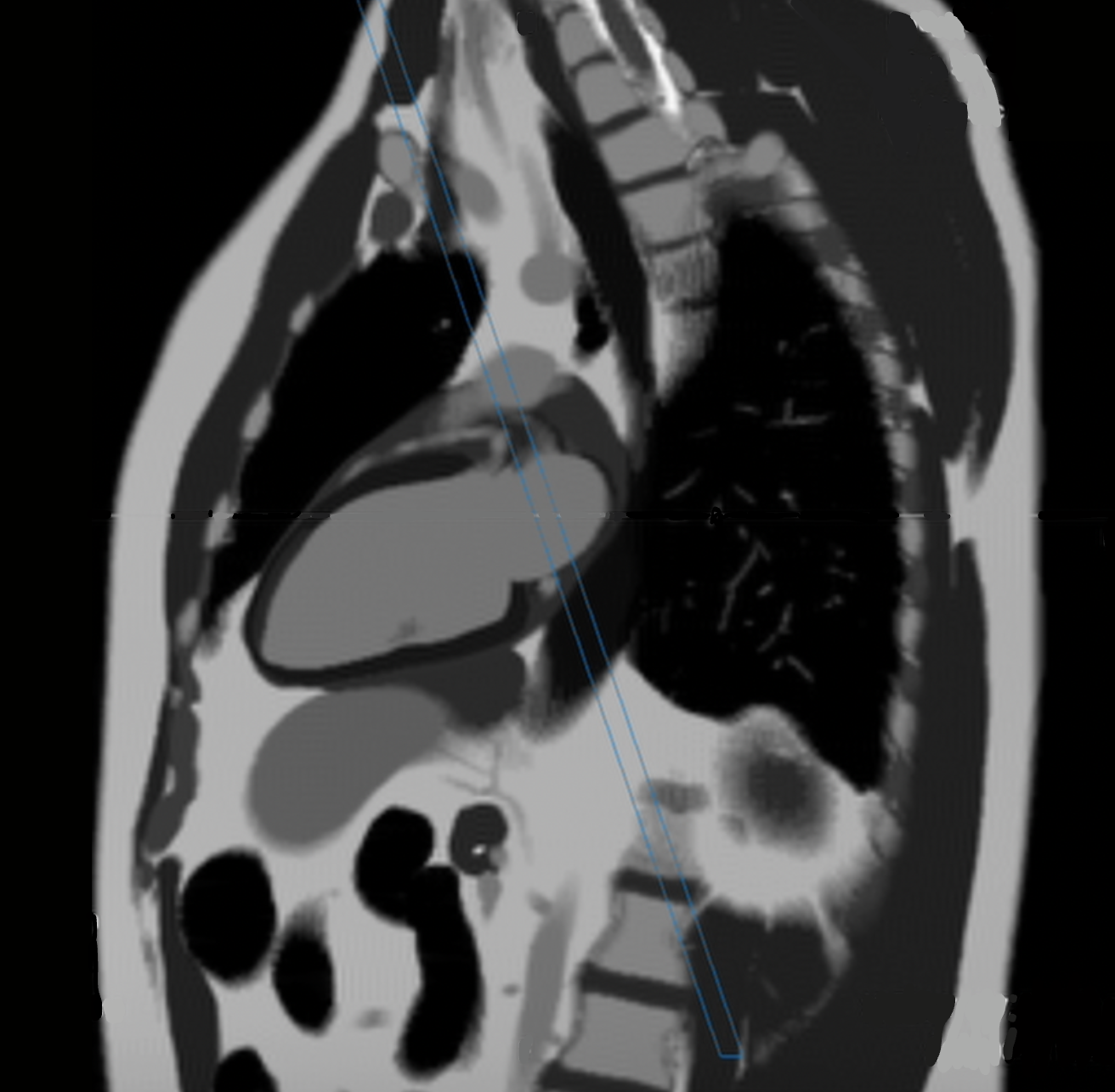 Pseudo 2-chamber view of the heart, correct image example