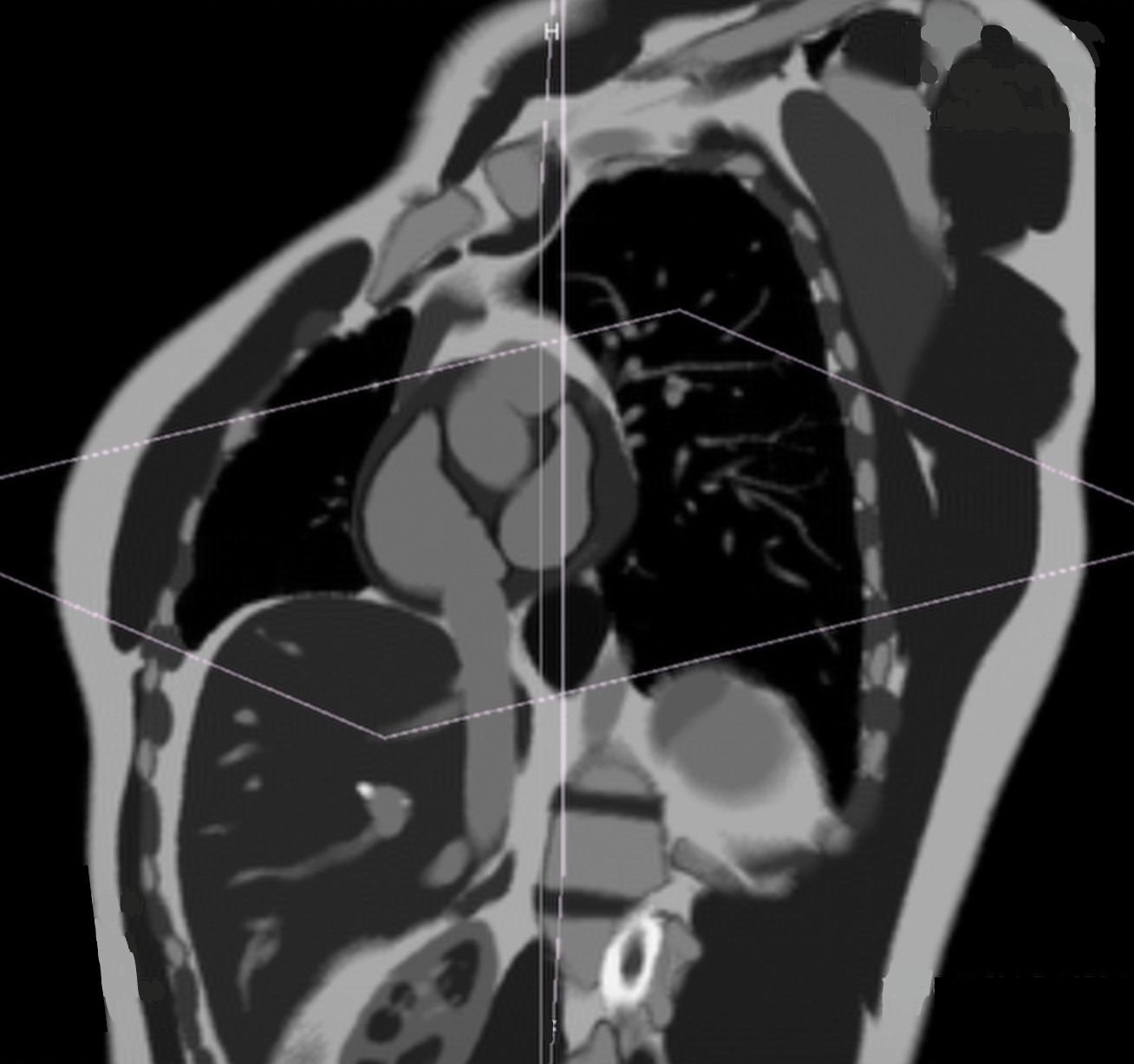 Pseudo short-axis (SAX) view of the heart, correct image example