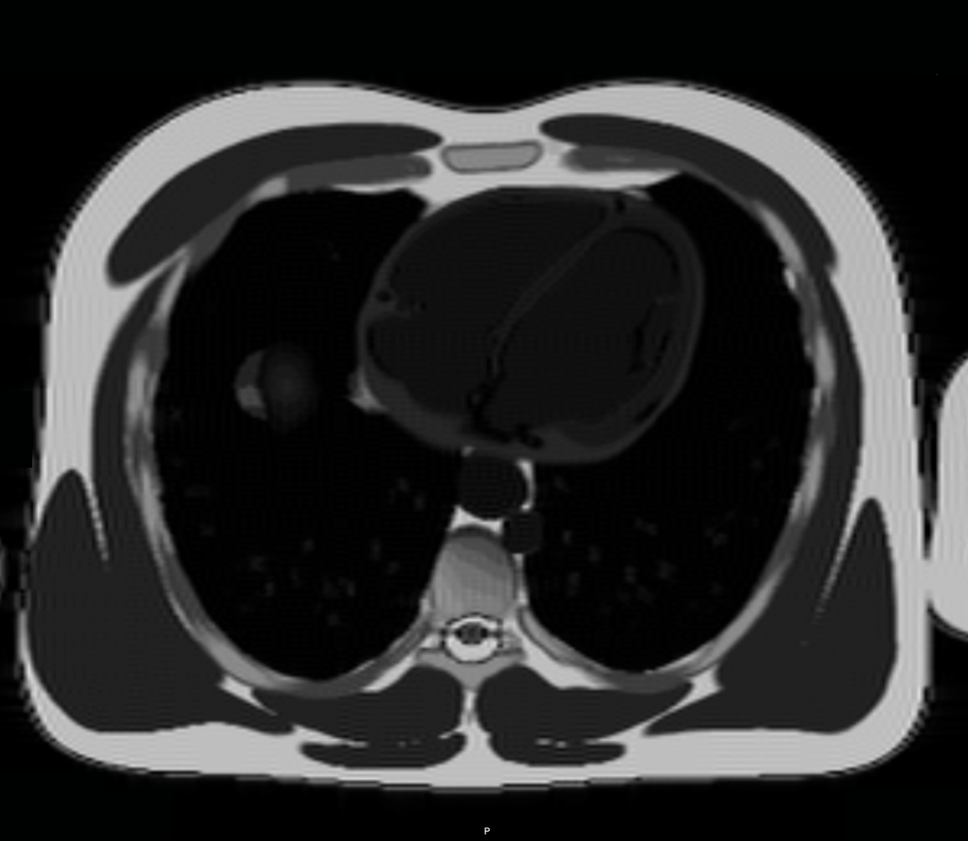 Black Blood IR-bSSFP – Correct Image Example