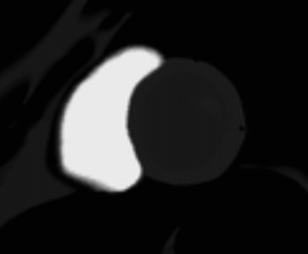 Short-Axis Rest Perfusion Gradient Echo – Correct Image Example