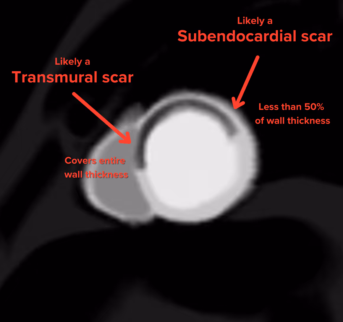 Cardiac perfusion defect showing transmural and subendocardial scar