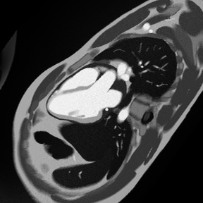 3-Chamber Early Gadolinium Enhancement – Correct Image Example