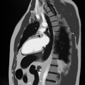 2-Chamber Early Gadolinium Enhancement – Correct Image Example