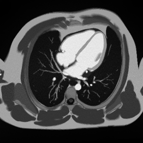 4-Chamber Early Gadolinium Enhancement – Correct Image Example