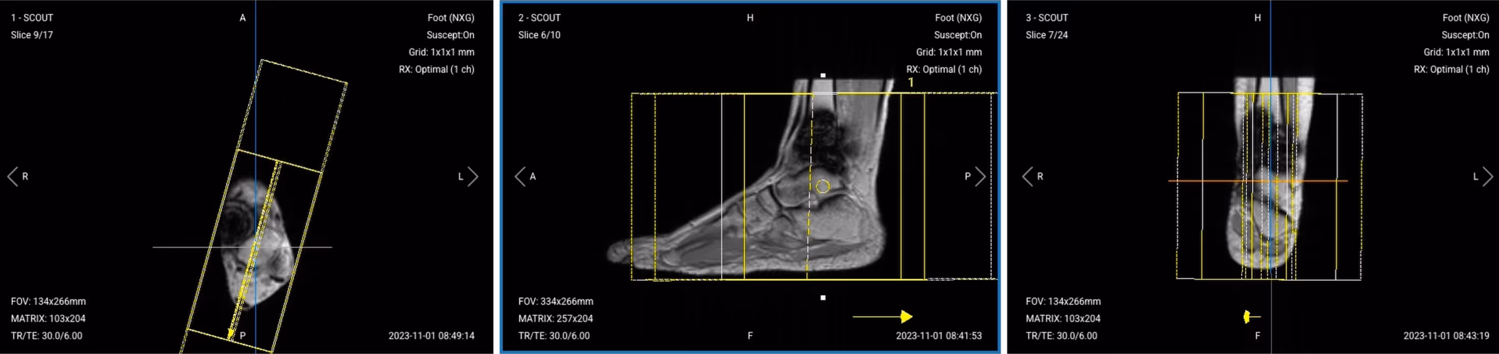 Correct slice planning of Sagittal T1 TSE