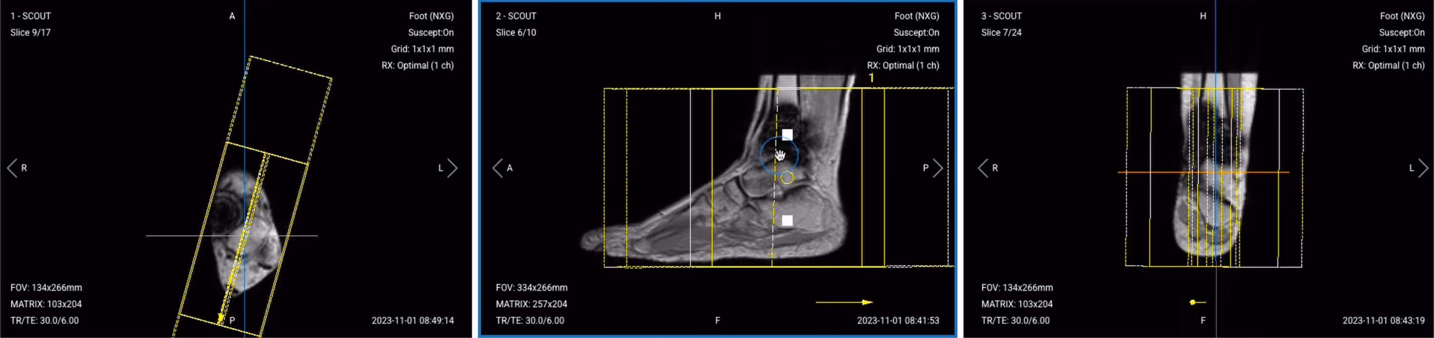Correct slice planning of Sagittal PD STIR TSE