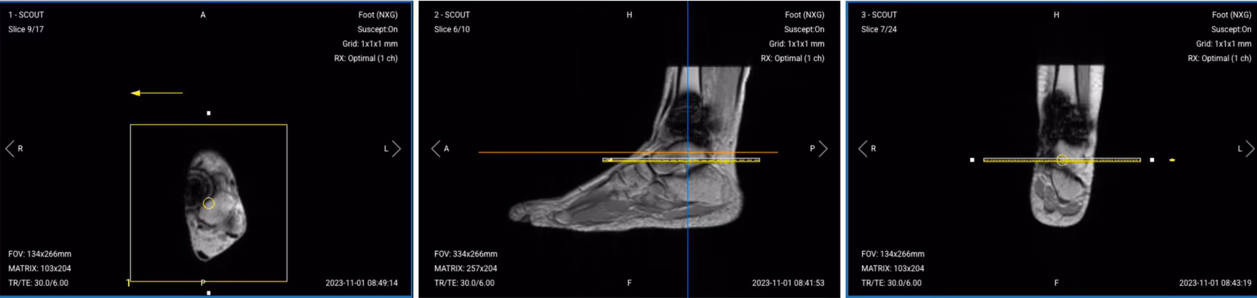 Correct slice planning of Axial PD STIR TSE