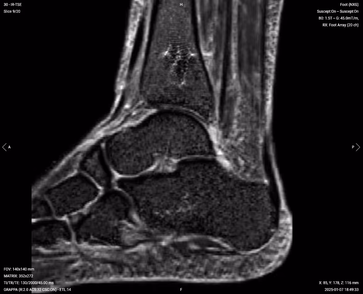 Coronal PD STIR – Correct Image Exampl