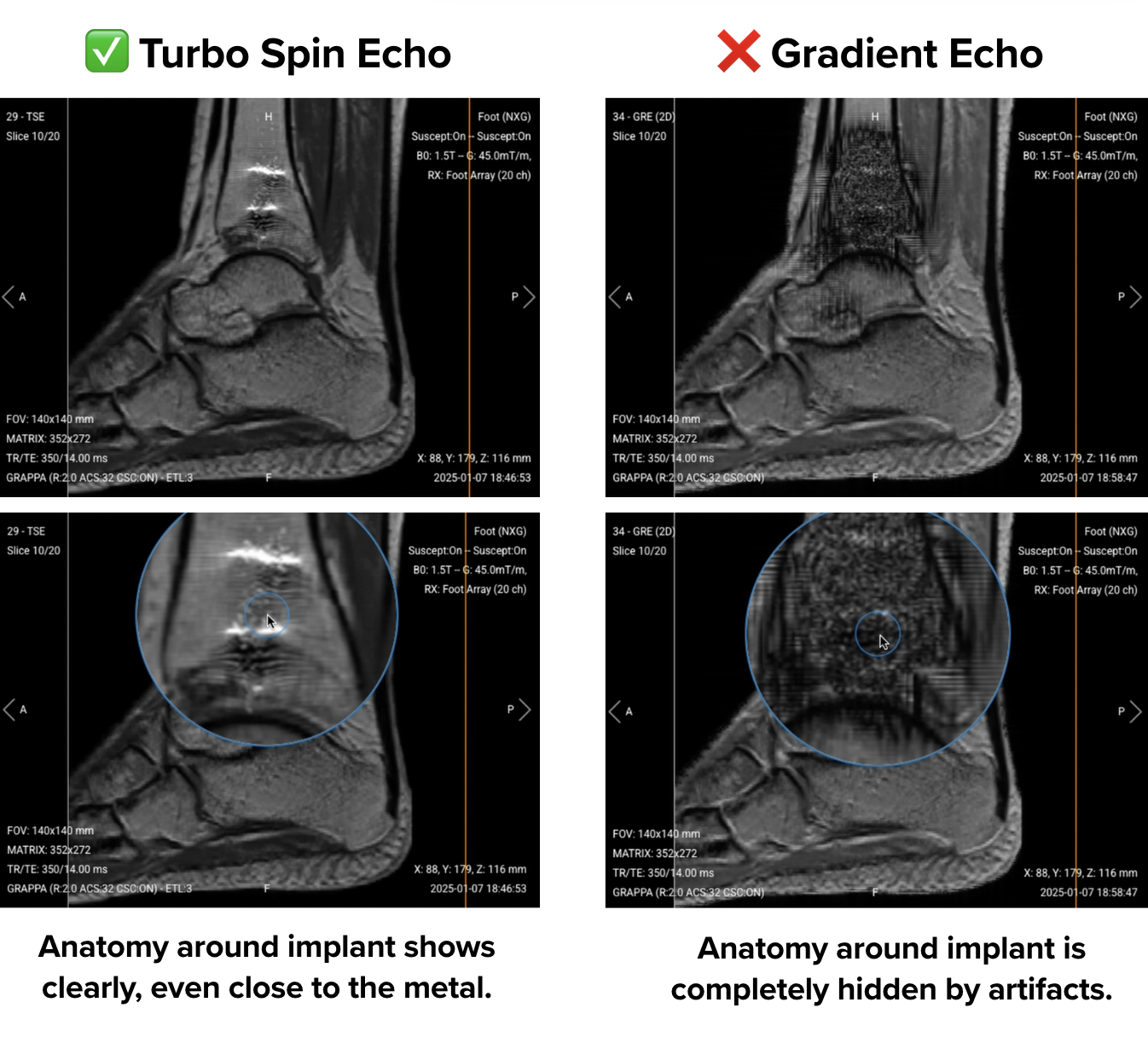 Turbo Spin Echo vs Gradient Echo. To the left, TSE images Anatomy around implant shows clearly, even close to the metal. To the right, GRE images show Anatomy around implant that is completely hidden by artifacts.