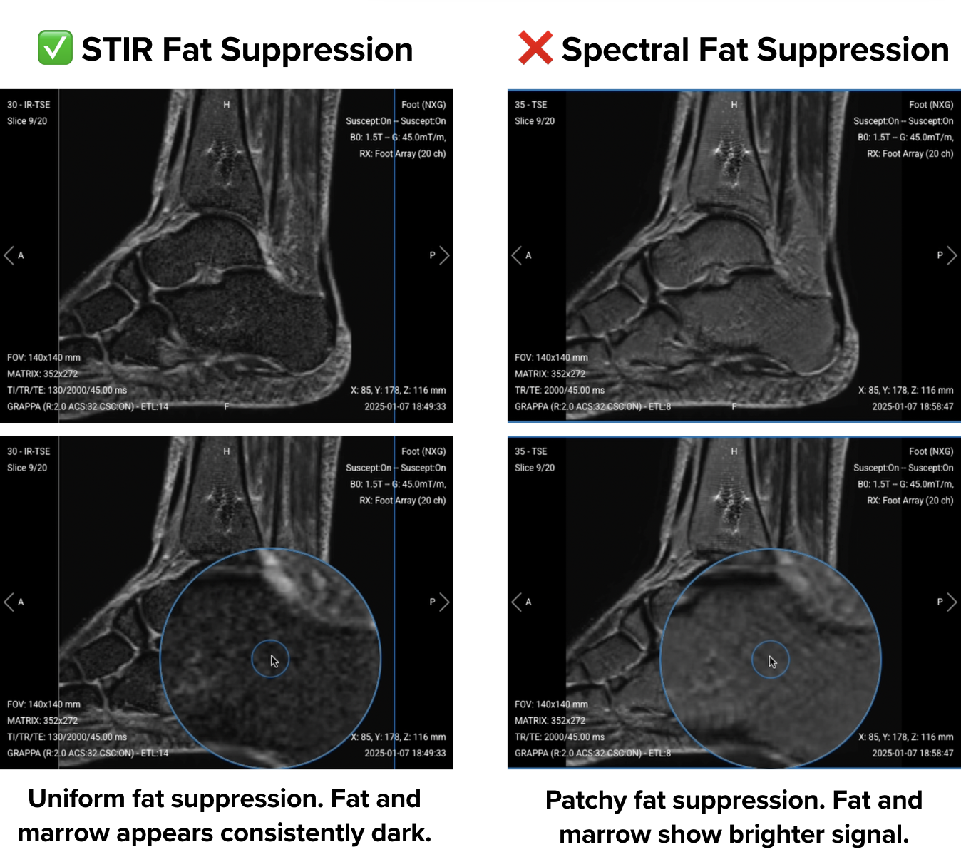 STIR vs spectra fat suppression. To the left, STIR images show uniform fat suppression where fat and marrow appears consistently dark. To the right, spectral images show patchy fat suppression where fat and marrow show brighter signal. 