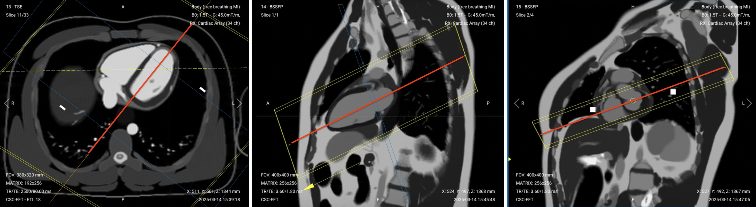 Correct Planning for 4-Chamber Sequence, early and late enhancement