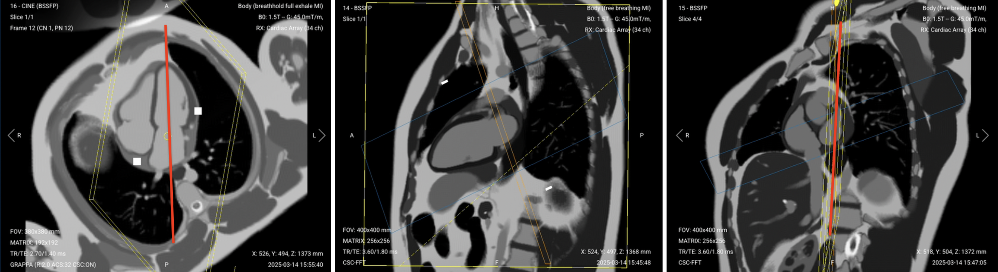 Correct Planning for 2-Chamber Sequence, early and late enhancement