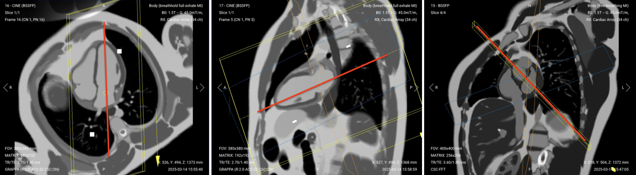 Correct Planning for 3-Chamber Sequence, early and late enhancement