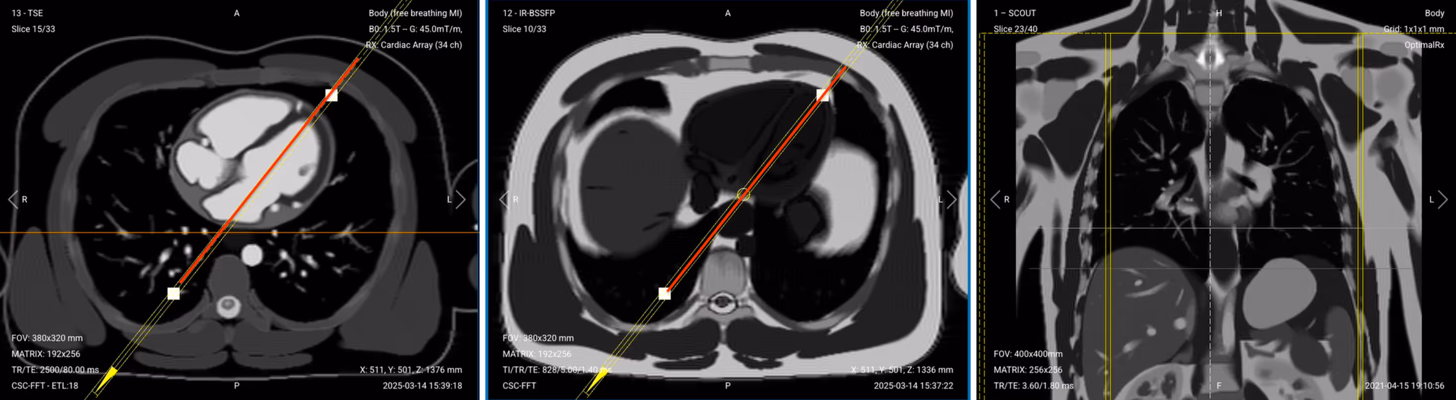 Correct Planning of Pseudo 2-Chamber View