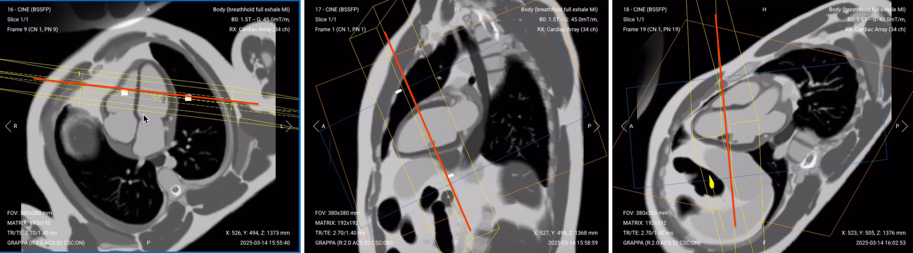 Correct Planning of Short-Axis (SAX) Perfusion GRE
