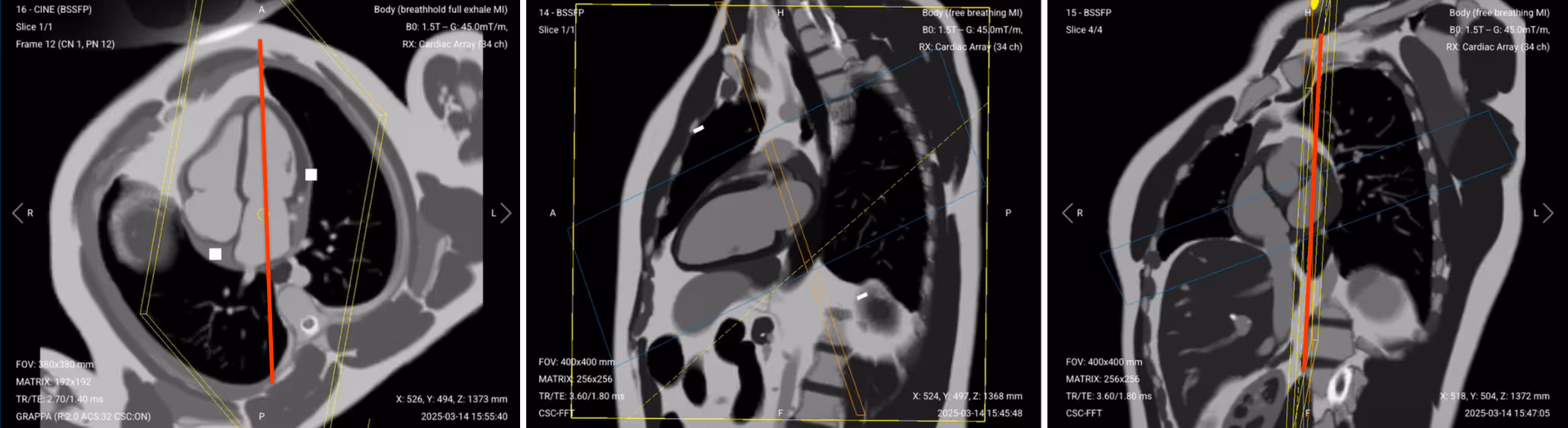 Correct Planning of 2-Chamber Cine
