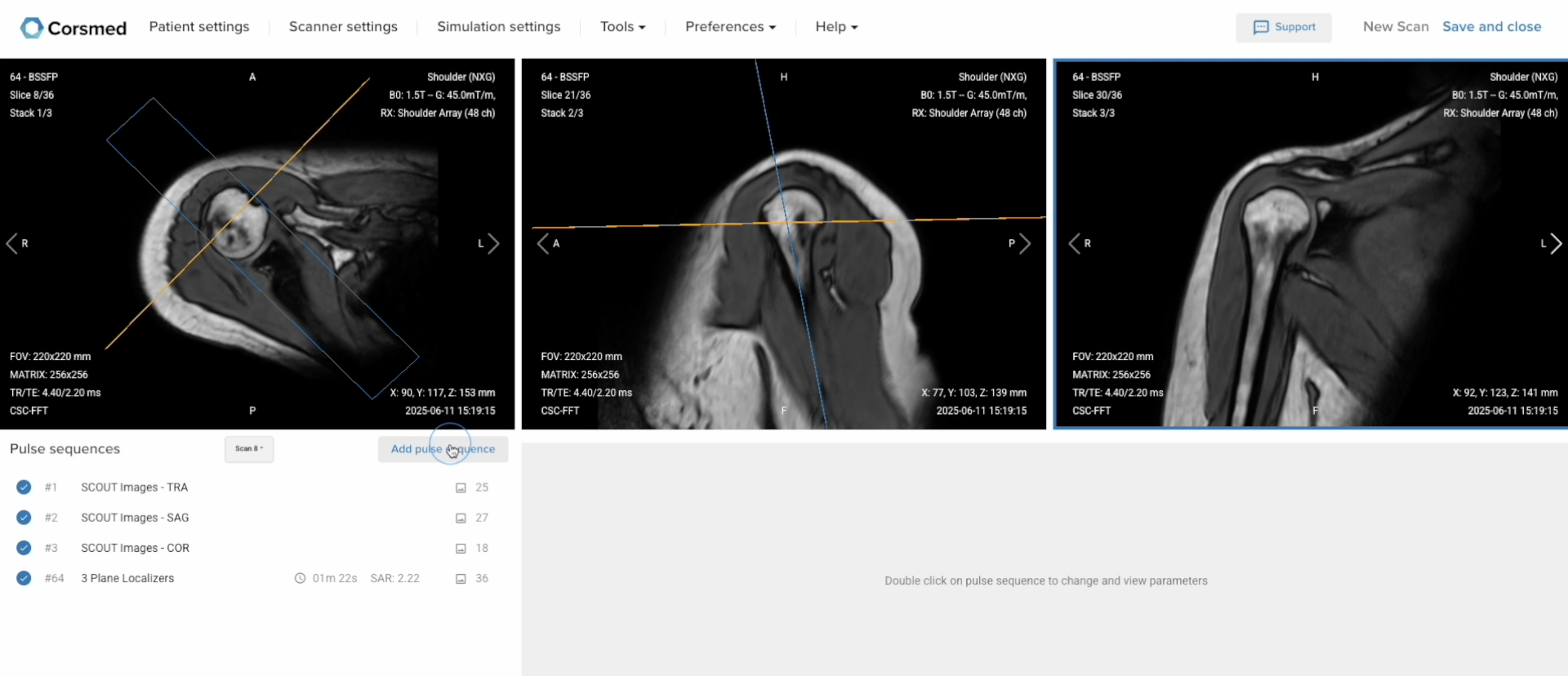 Correct Setup of Localizer Images for Shoulder MRI
