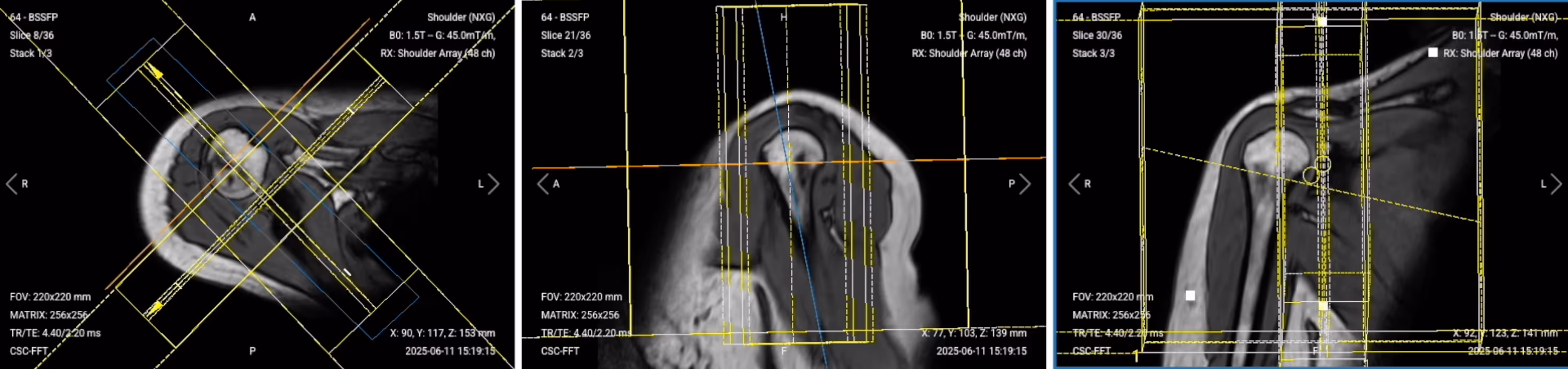 Correct Planning of Two-Plane Localizer (Sagittal and Coronal Views)