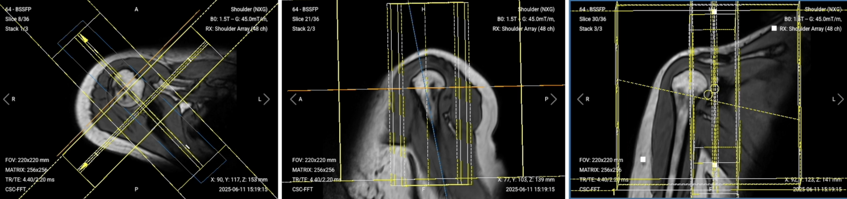 Correct Planning of Two-Plane Localizer (Sagittal and Coronal Views)