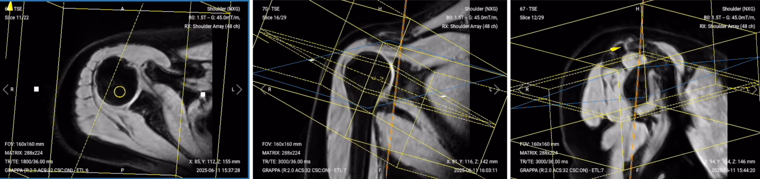 Correct Planning of Axial PD Fat-Saturated TSE