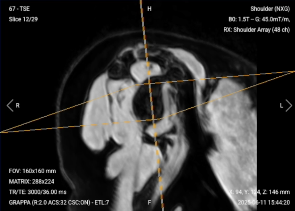 Sagittal PD FS of the Shoulder – Correct Image Example