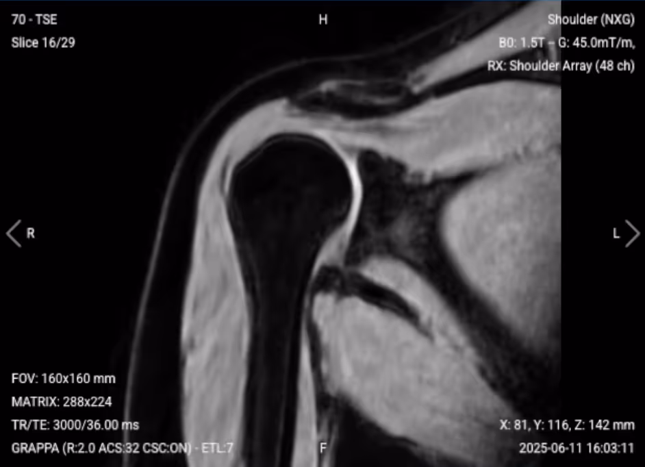Coronal PD FS of the Shoulder – Correct Image Example