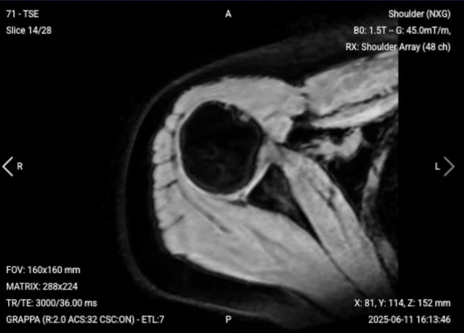 Axial PD FS of the Shoulder – Correct Image Example