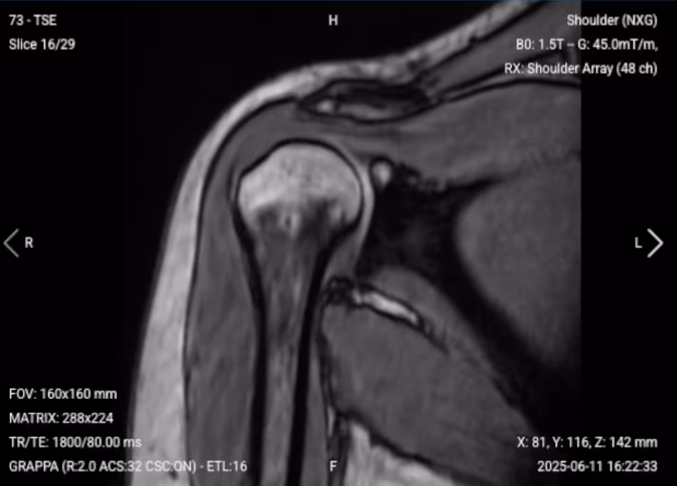 oronal T2 of the Shoulder – Correct Image Example