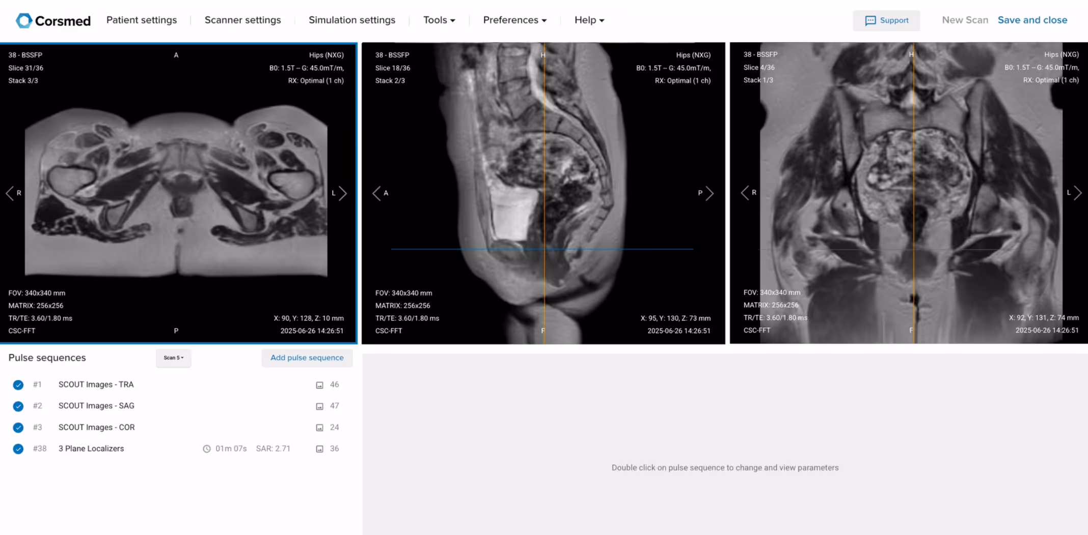 Correct Setup of Localizer Images for Anal Fistula MRI