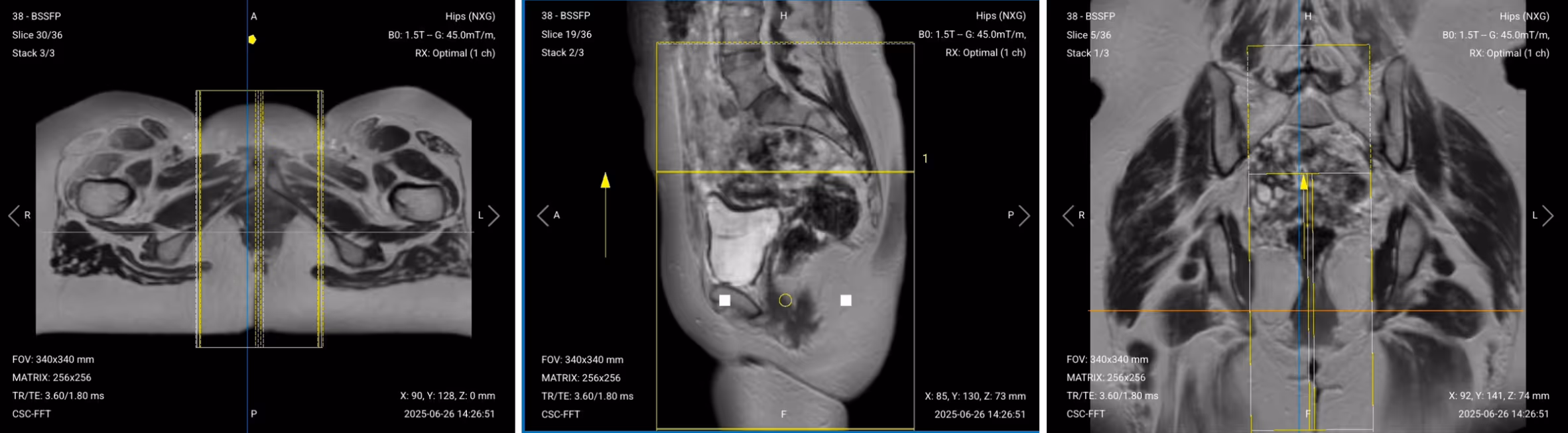 Correct Planning of Sagittal T2 TSE High Resolution
