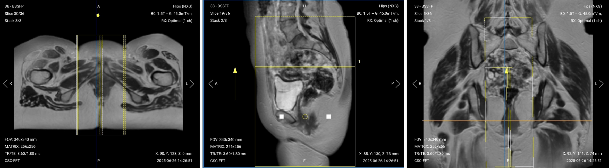 Correct Planning of Sagittal T2 TSE High Resolution