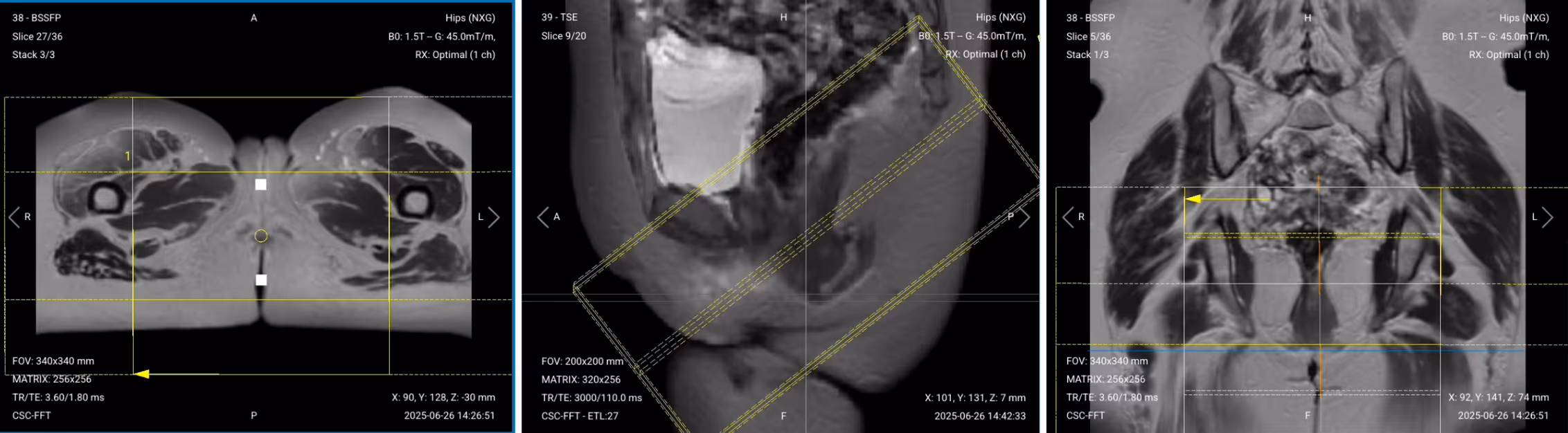 Correct planning of Axial PD Fat-Saturated TSE