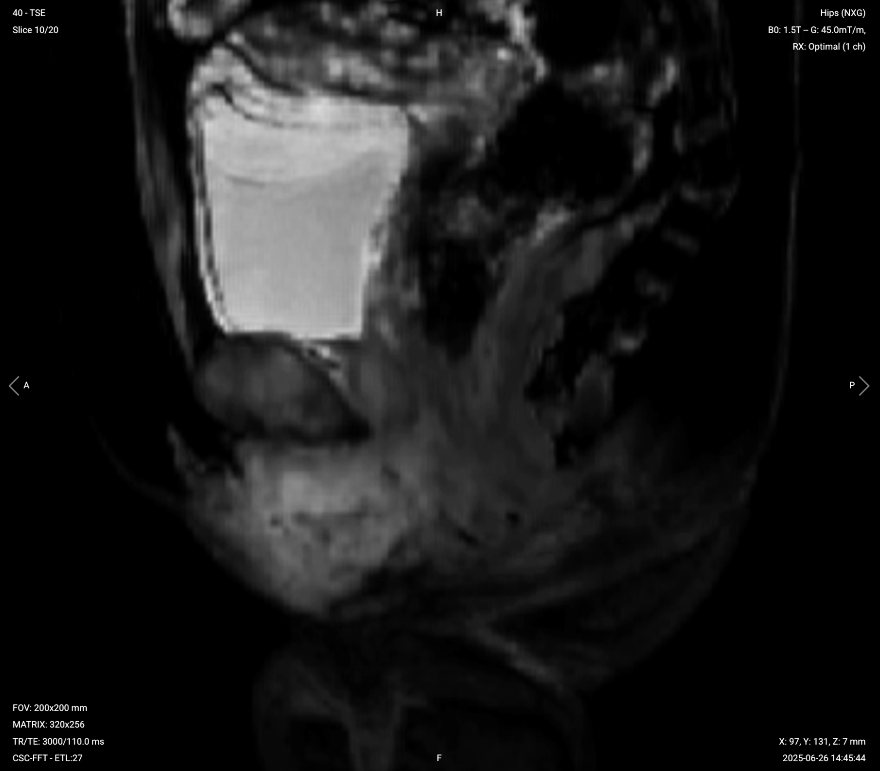 Sagittal T2 SPAIR – Example of Poor Fat Suppression