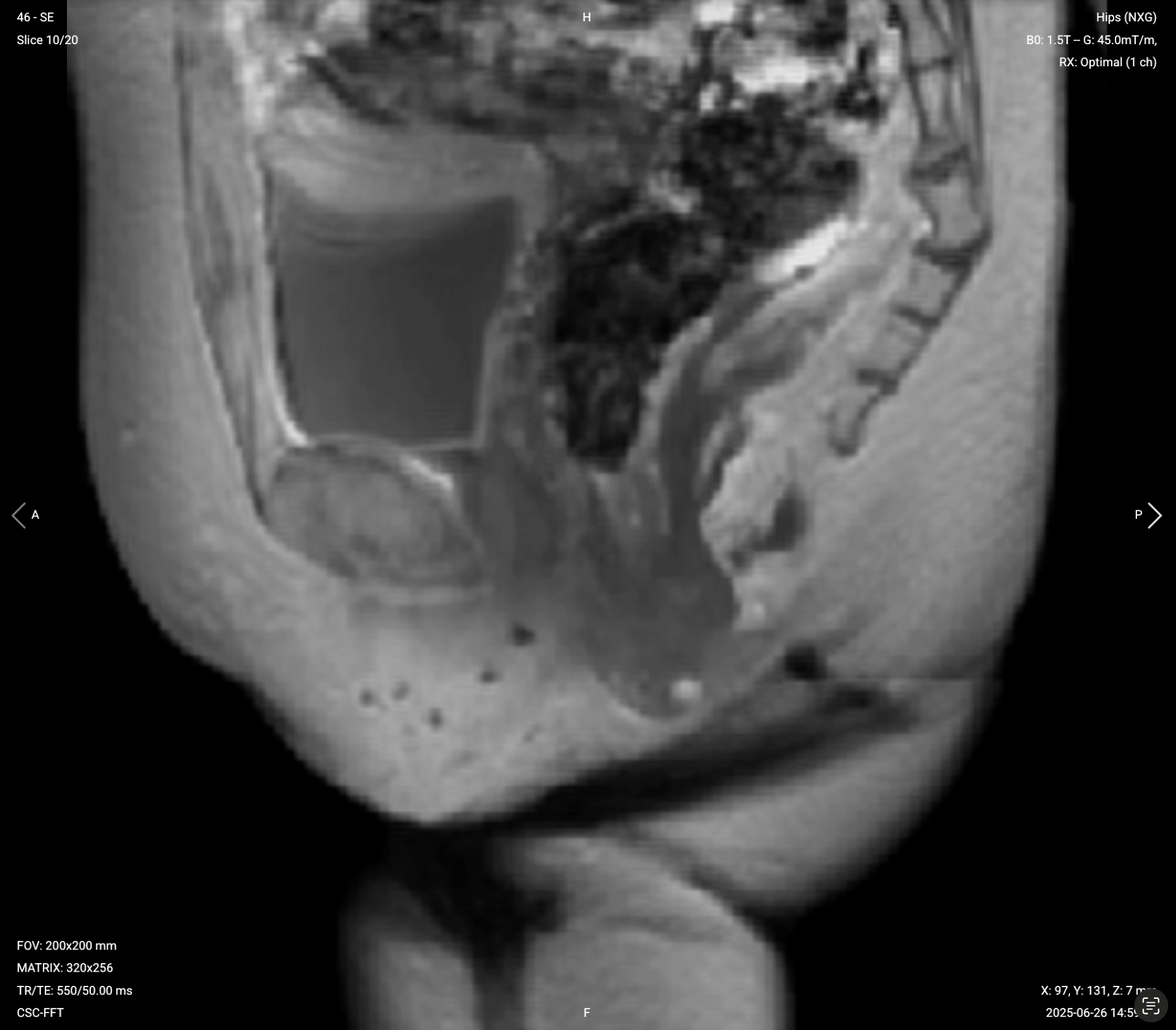 Sagittal T1 TSE Pre-contrast of Anal Canal – Correct Image Example
