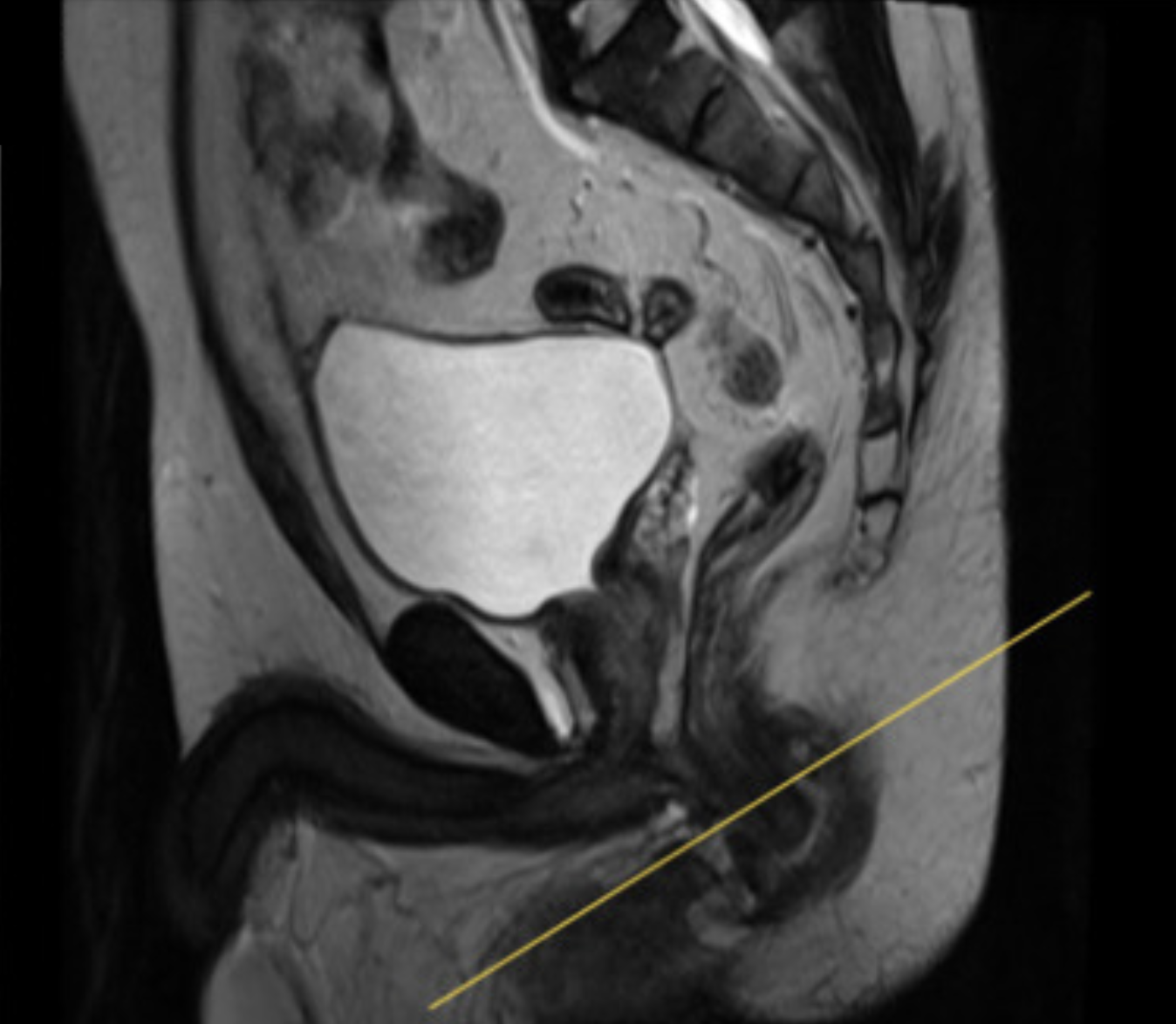 Sagittal T1 TSE Post-contrast of Anal Canal – Correct Image Example