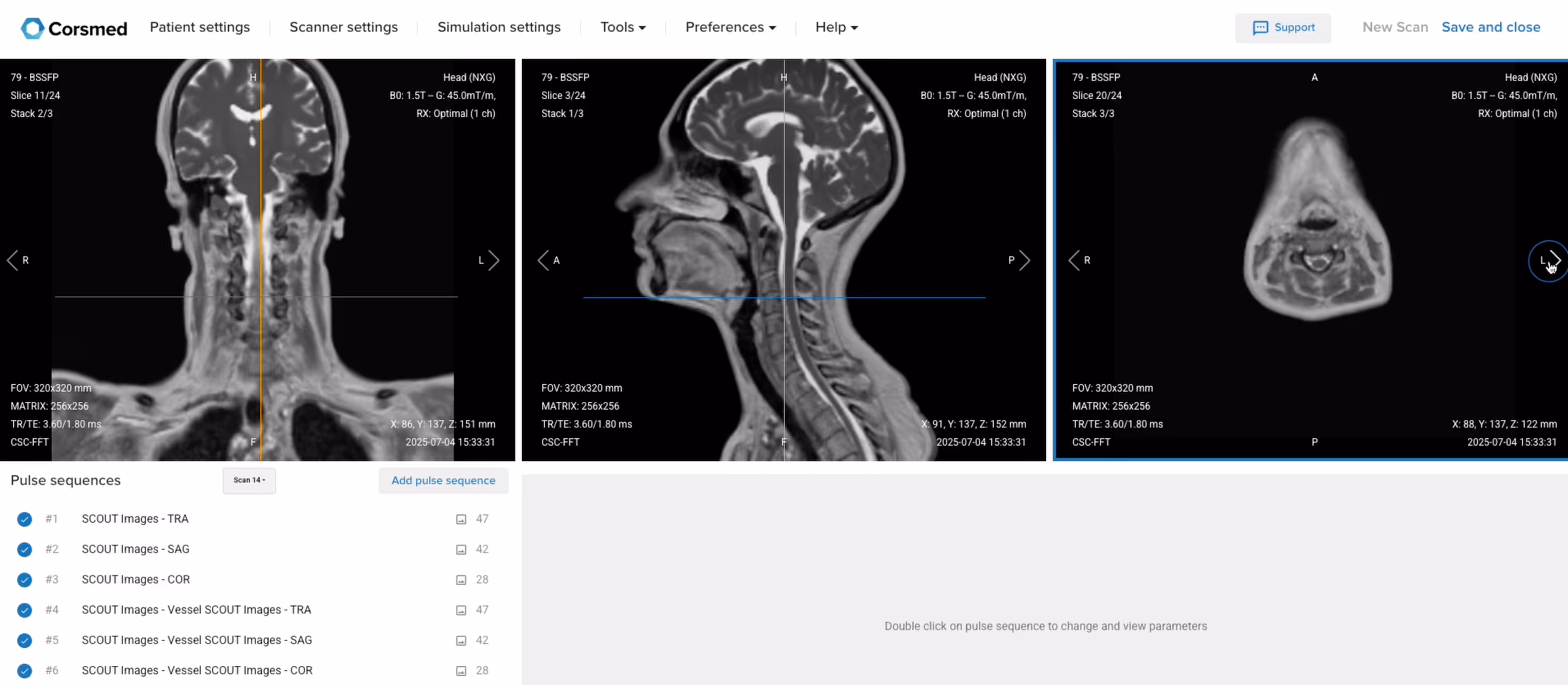 Correct setup of localizer images for Cervical Spine MRI