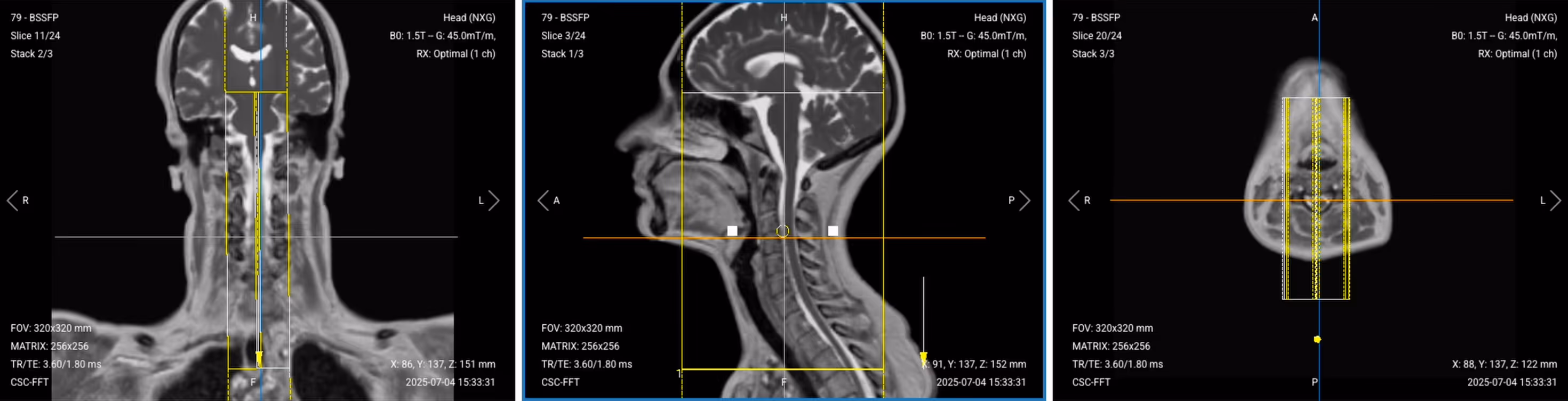 Correct Planning of Sagittal T2 TSE