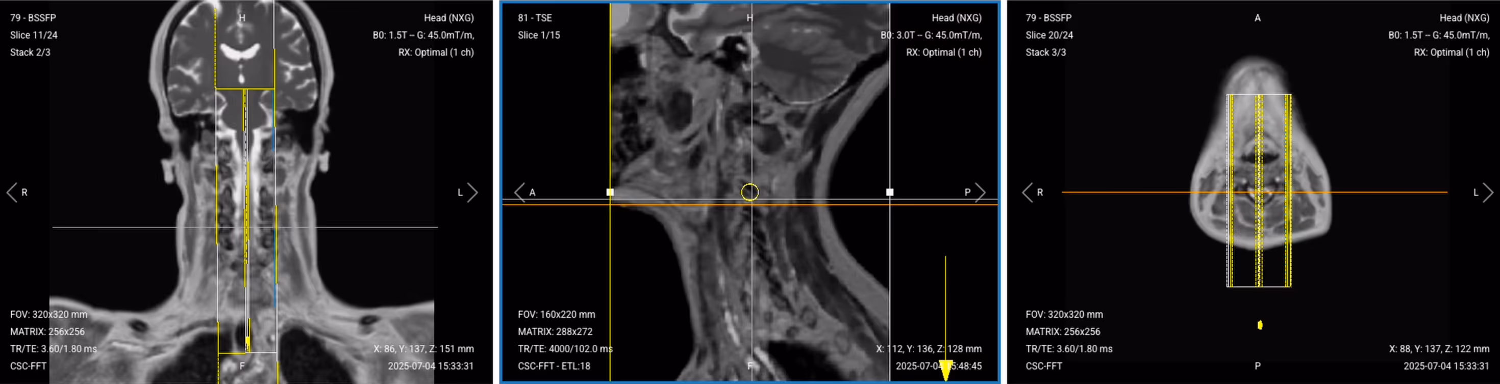 Correct planning of sagittal STIR TSE