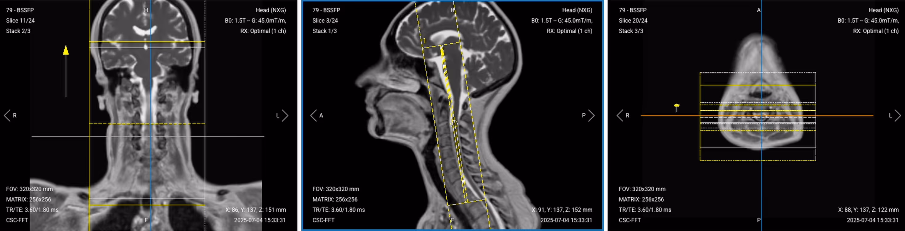 Correct Planning of Coronal T2 TSE